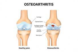 Physical Therapy for Arthritic Joints